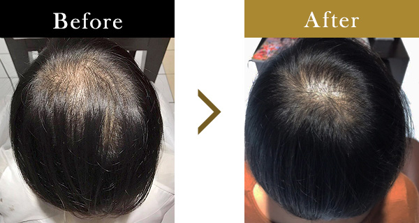 頭頂部の薄毛にお悩みの40歳女性