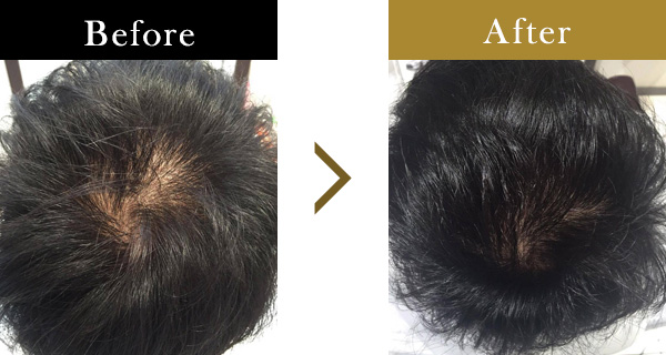 頭頂部の薄毛にお悩みの38歳男性