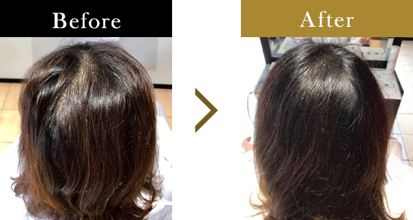 頭頂部の薄毛にお悩みの52歳女性