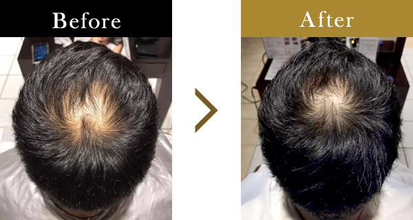 頭頂部の薄毛にお悩みの33歳男性
